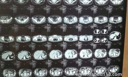 胰腺不舒服早期大便會變化嗎(胰腺有問題會不會打嗝)(圖2) 胰腺不舒服早期大便會變化嗎2