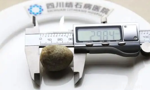 腎結石3mm需要吃藥嗎2